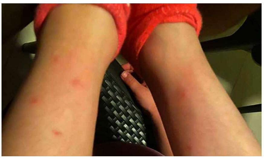 Alanya’da ‘Sivrisinek istilası’ isyanı: Çocukların vücutları yara içerisinde