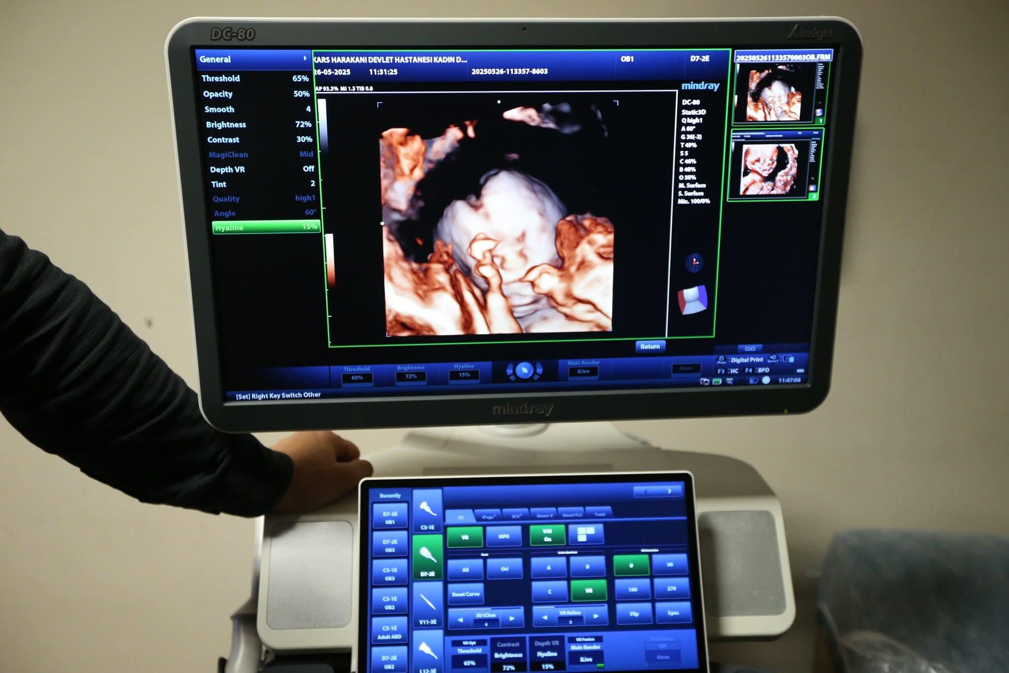 Kars’ta 4 boyutlu ultrason dönemi başladı! – Birlik Haber Ajansı